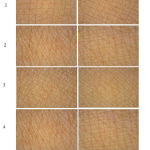 Figure 2: Appearance of the skin surface before and after using the PLES serum for 8 weeks.