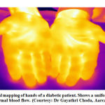Figure 1: Thermal mapping of hands of a diabetic patient.