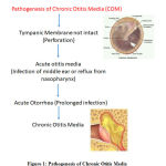 Figure 1: Pathogenesis of Chronic Otitis Media