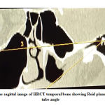 Figure 2: Oblique sagittal image of HRCT temporal bone showing Reid plane – Eustachian tube angle