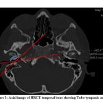 Figure 3: Axial image of HRCT temporal bone showing Tubo-tympanic angle