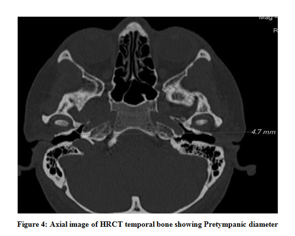 Evaluation Of Eustachian Tube Ct Measurements In Patients With Com And Cholesteatoma 6946