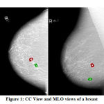 Figure 1: CC View and MLO views of a breast
