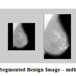 Figure 10: Segmented Benign Image – mdb160