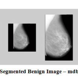 Pectoral Muscle Segmentation in Mammograms – Biomedical and ...