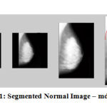 Figure 11: Segmented Normal Image – mdb003