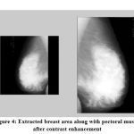 Figure 4: Extracted breast area along with pectoral muscle after contrast enhancement