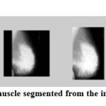 Figure 6: Pectoral muscle segmented from the image mdb105