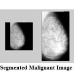 Figure 8: Segmented Malignant Image – mdb130