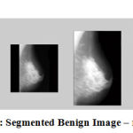 Figure 9: Segmented Benign Image – mdb121