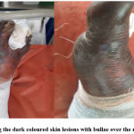 Figure 2: Showing the dark coloured skin lesions with bullae over the right foot (Dorsum)