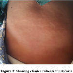 Figure 3: Showing classical wheals of urticaria