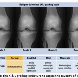 An Overview of Medical Imaging Techniques for Knee Osteoarthritis ...