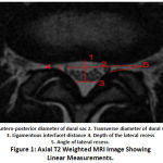 Figure 1: Axial T2 Weighted MRI Image Showing Linear Measurements.