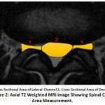 Figure 2: Axial T2 Weighted MRI Image Showing Spinal Canal Area Measurement.