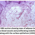 Figure 2: H&E section showing mass of adipose tissue with numerous blood vessels and proliferating endothelial cells along with the surface epithelium (100X)