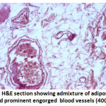 Figure 3: H&E section showing admixture of adipose tissue and prominent engorged  blood vessels (400X)