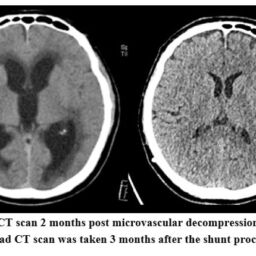 Slow-Chronic Progressive Hydrocephalus as Complication of Microvascular ...