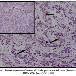 Analyzing the Expression of MicroRNA-375 and its Target Gene p53 in ...