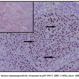Analyzing the Expression of MicroRNA-375 and its Target Gene p53 in ...