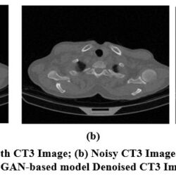 Generative Adversarial framework for CT image denoising using Self ...